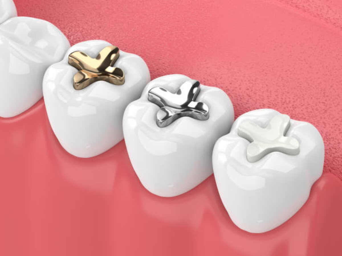 Illustration of gold, silver and white dental fillings
